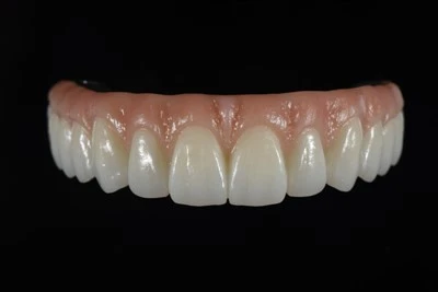 ออกแบบแบบดิจิทัลทั้งหมด-บน-สะพาน X Zirconia